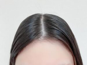 つむじの透け感を解消！錦美容クリニックの頭皮アートメイク（SMP）ビフォーアフター